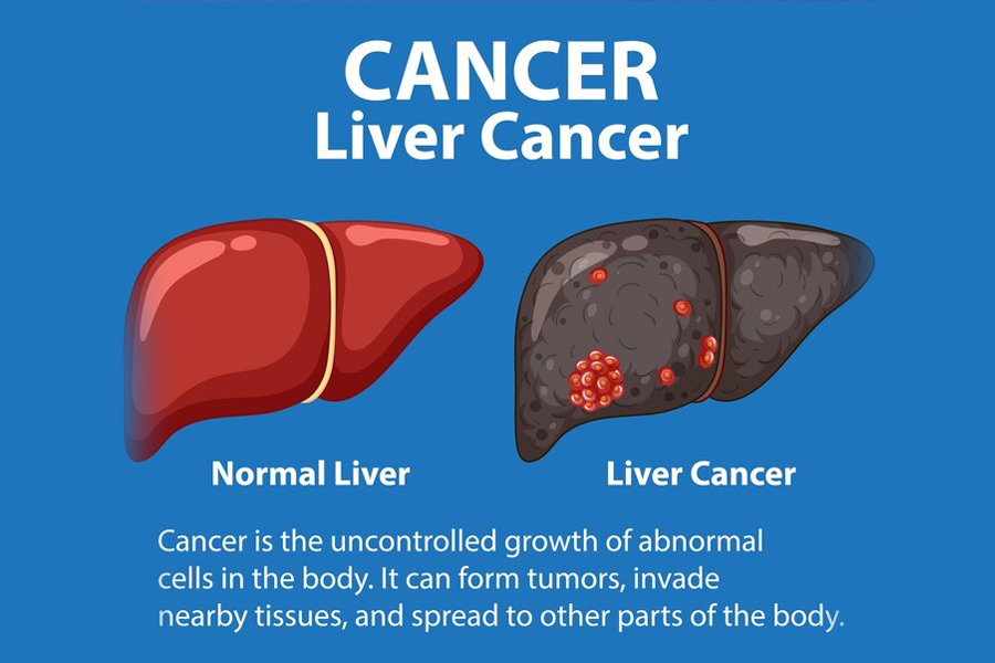 Here's How You Can Prevent Cancer Due To Untreated Diabetes 