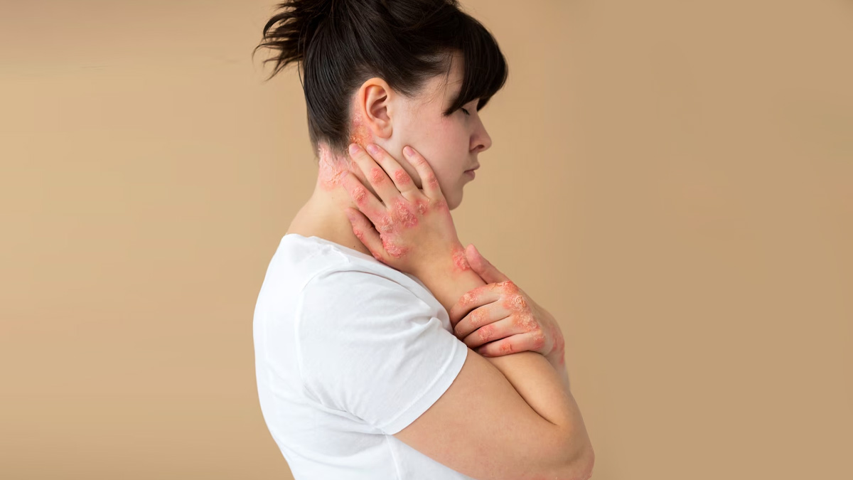 Beyond The Skin: Expert Explains Psychological, Emotional, And Social Burden Of Psoriasis