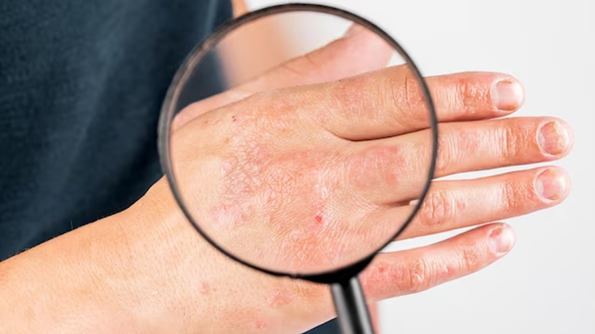 fungal infection vs eczema 