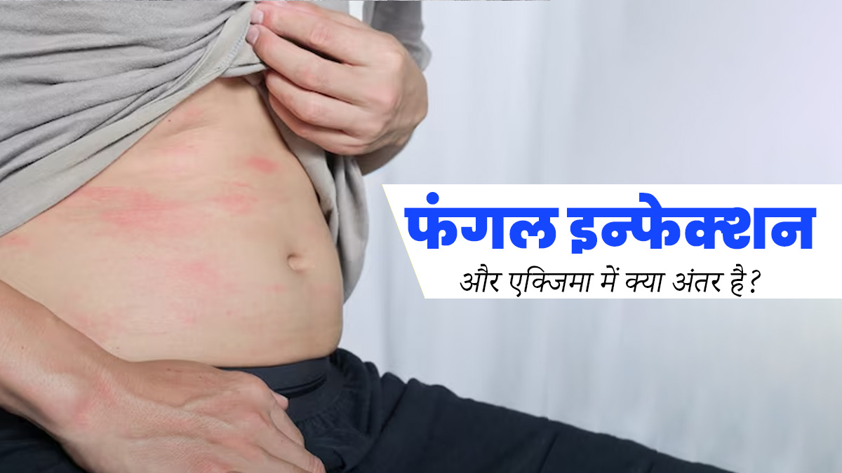 Fungal Infection vs Eczema: फंगल इन्‍फेक्‍शन और एक्‍ज‍िमा में क्‍या अंतर है? जानें इनके लक्षण 