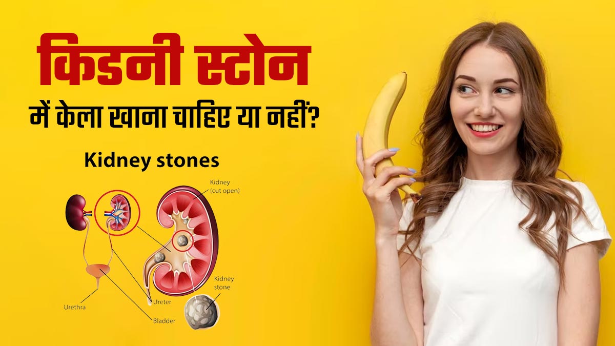 किडनी स्टोन में केला खाना चाहिए या नहीं? जानें क्या कहते हैं एक्सपर्ट