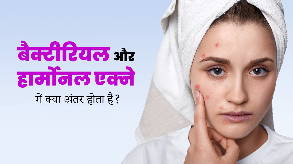 बैक्टीरियल और हार्मोनल एक्ने में क्या अंतर होता है? जानें कैसे करें बचाव