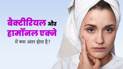 बैक्टीरियल और हार्मोनल एक्ने में क्या अंतर होता है? जानें कैसे करें बचाव