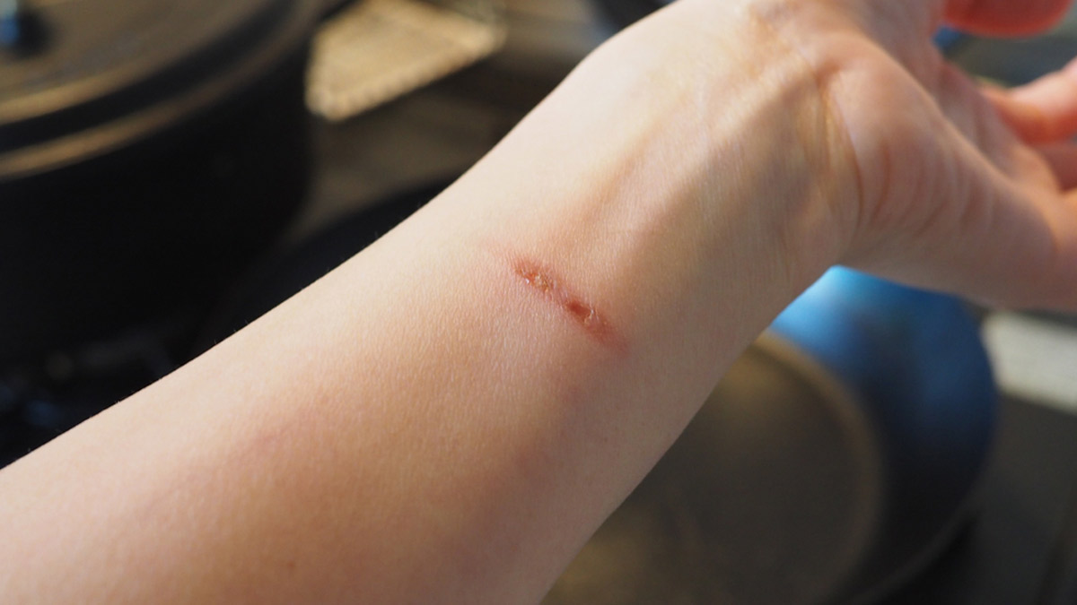 Effective Home Remedies for Minor Burns: Simple Solutions To Soothe And Heal