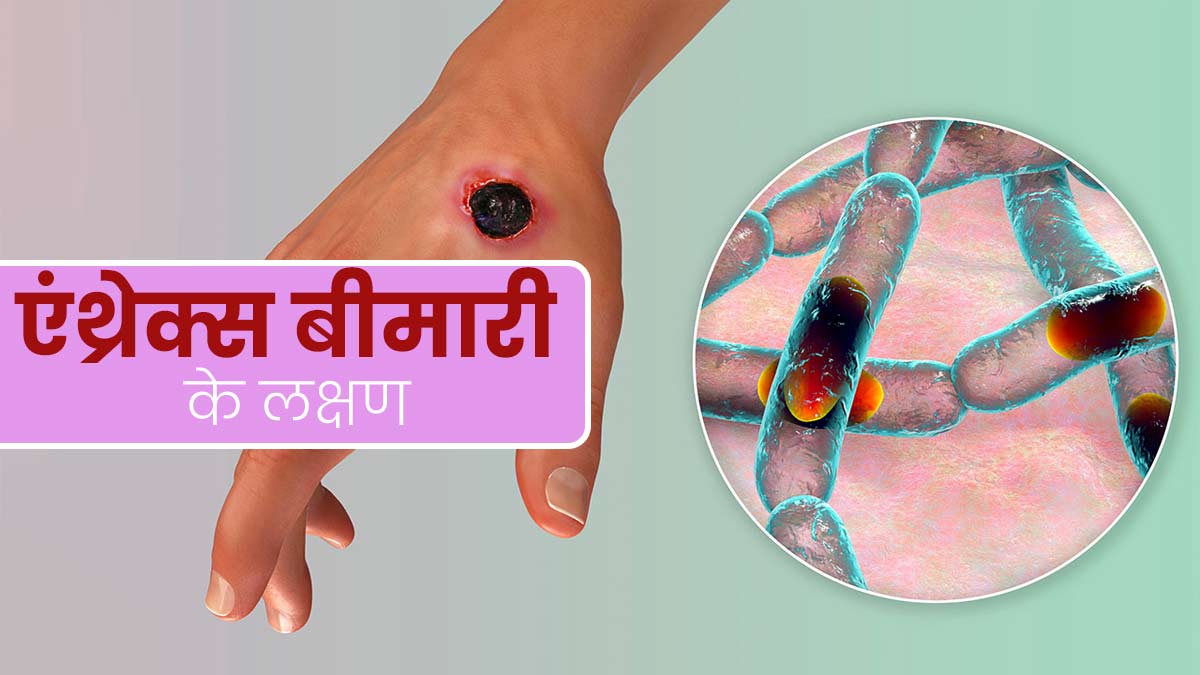 ओडिशा के कोरापुट में एंथ्रेक्स से संक्रमित हुए 2 लोग, जानें इस दुर्लभ बीमारी के लक्षण, कारण और इलाज