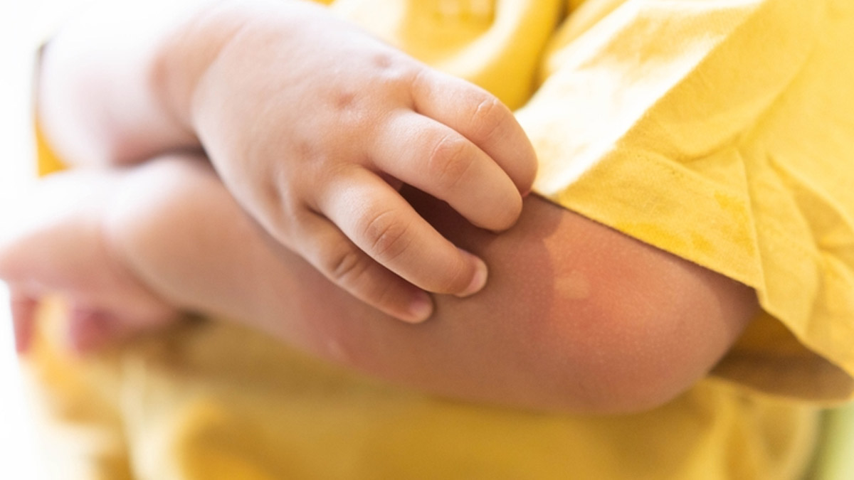 Doctor Warns Of Increasing Dengue Cases Among Children, Shares Preventive Measures