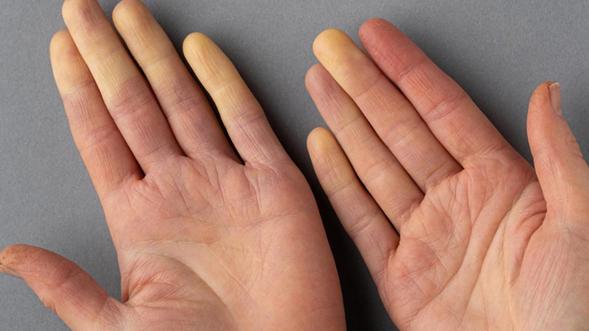 Scleroderma Explained: Causes, Symptoms, Diagnosis, Management