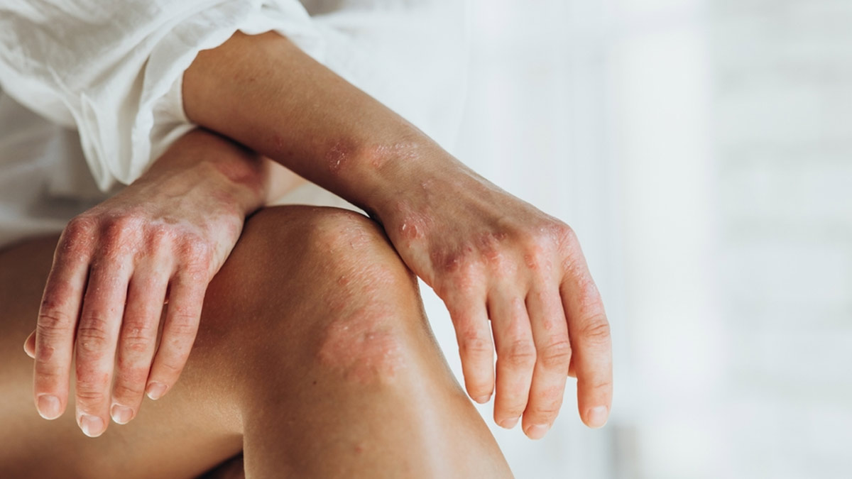 Signs Of Psoriatic Arthritis On Your Hands, Fingers, And Nails