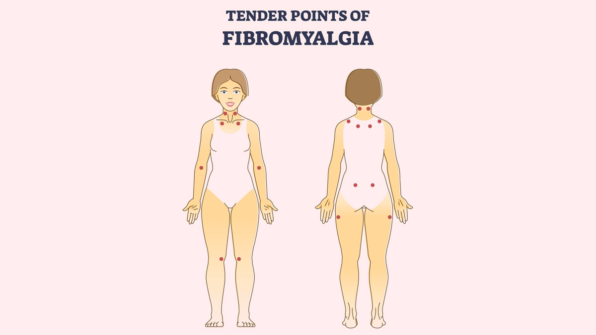 fibromyalgia-tender-points
