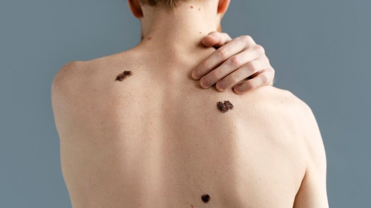 External Hemangiomas in Hindi