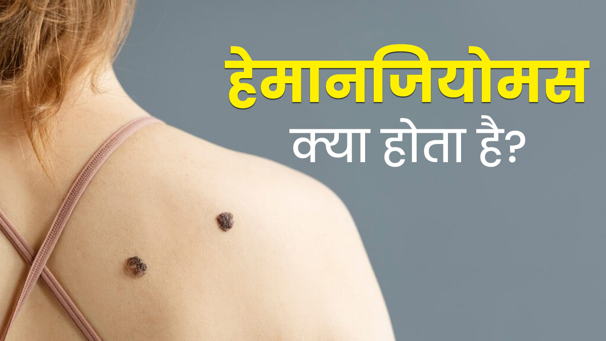 हेमानजियोमस को बर्थ मार्क समझने की न करें भूल, जानें इनके गंभीर नुकसान