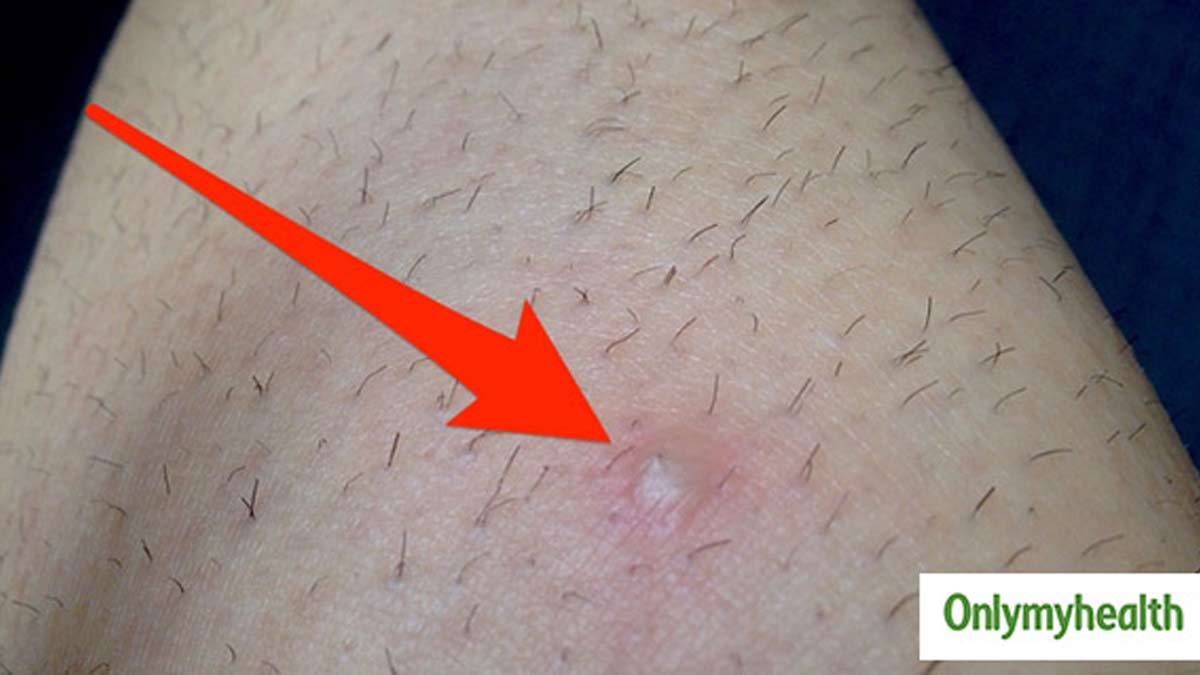 ingrown hair cyst