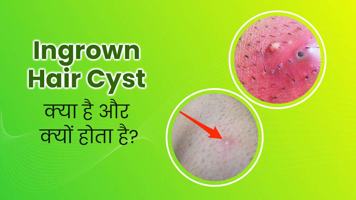 Ingrown Hair Cyst: त्वचा के छोटे बाल बन सकते हैं इनग्रोन हेयर सिस्ट का कारण, जानें इससे बचने के उपाय 