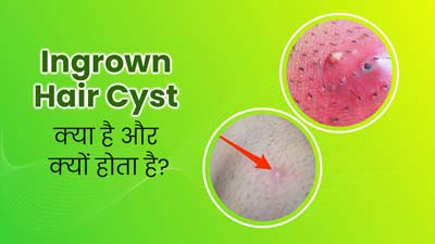 Ingrown Hair Cyst: त्वचा के छोटे बाल बन सकते हैं इनग्रोन हेयर सिस्ट का कारण, जानें इससे बचने के उपाय 