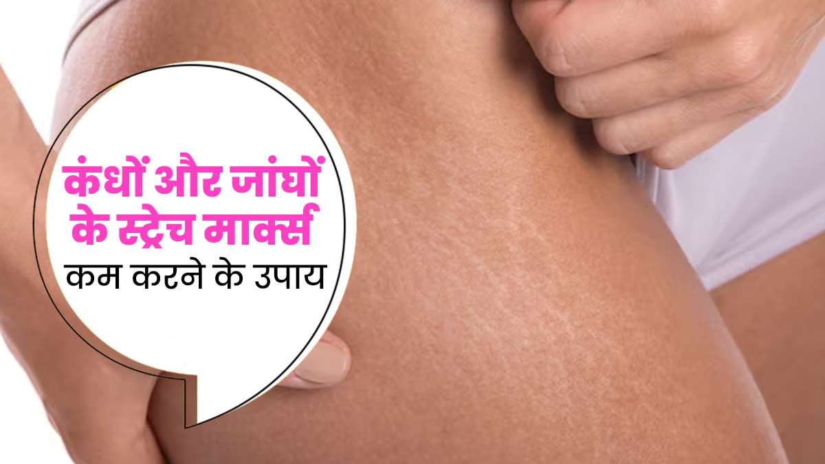 कंधों और जांघों पर होने वाले स्ट्रेच मार्क्स को कम करने के लिए आजमाएं ये 5 उपाय, दूर होगी समस्या