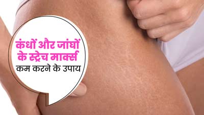 कंधों और जांघों पर होने वाले स्ट्रेच मार्क्स को कम करने के लिए आजमाएं ये 5 उपाय, दूर होगी समस्या