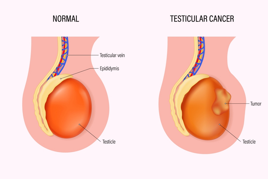 testicular-cancer-