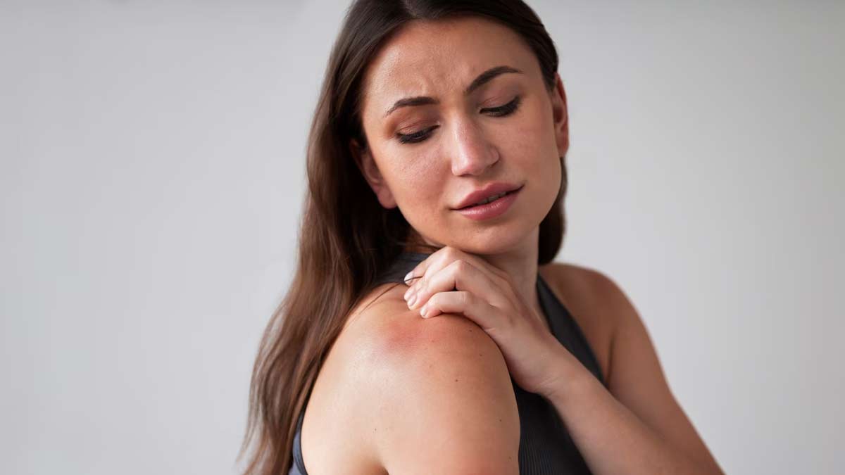 prickly heat marks home remedies 