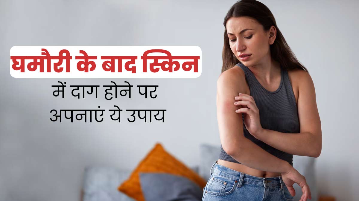 घमौरियों के निशान मिटाने के लिए अपनाएं ये 5 घरेलू उपाय, त्वचा बनेगी बेदाग और खूबसूरत