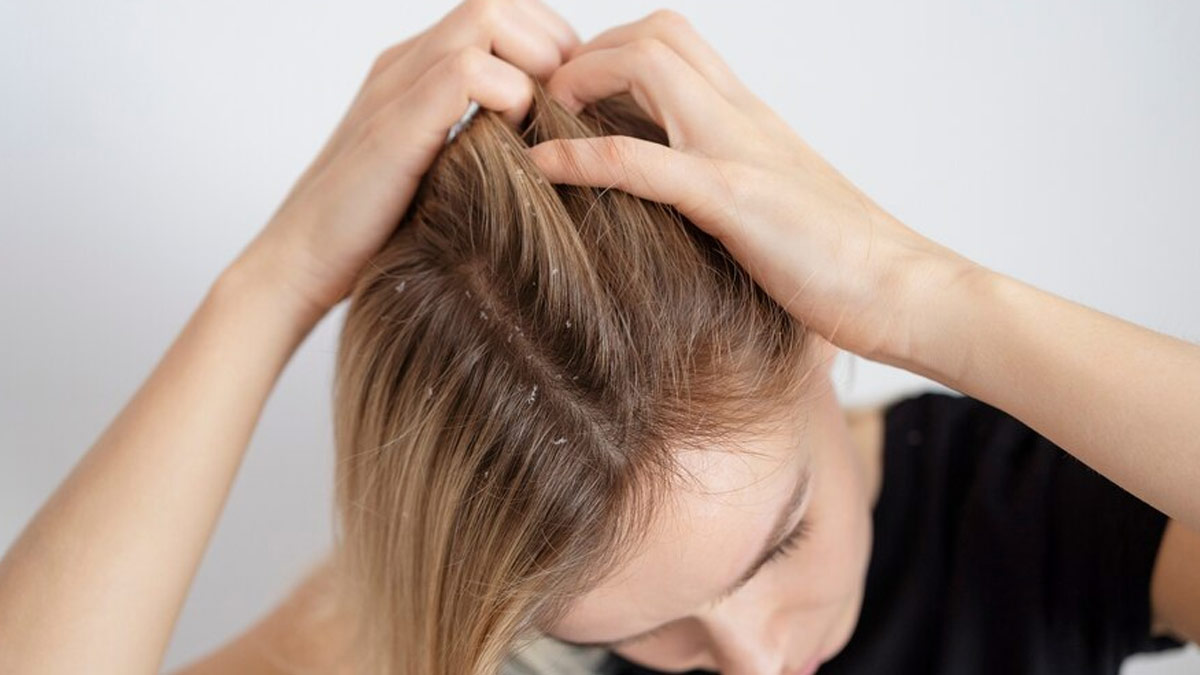 Does Your Scalp Feel Itchy During Monsoon? Here Are Its Causes and Remedies to Try