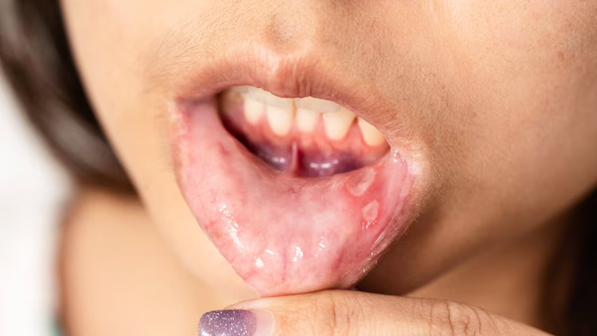 Mouth Sores May Indicate Stomach Issues: A Gastroenterologist Shares Why It Happens