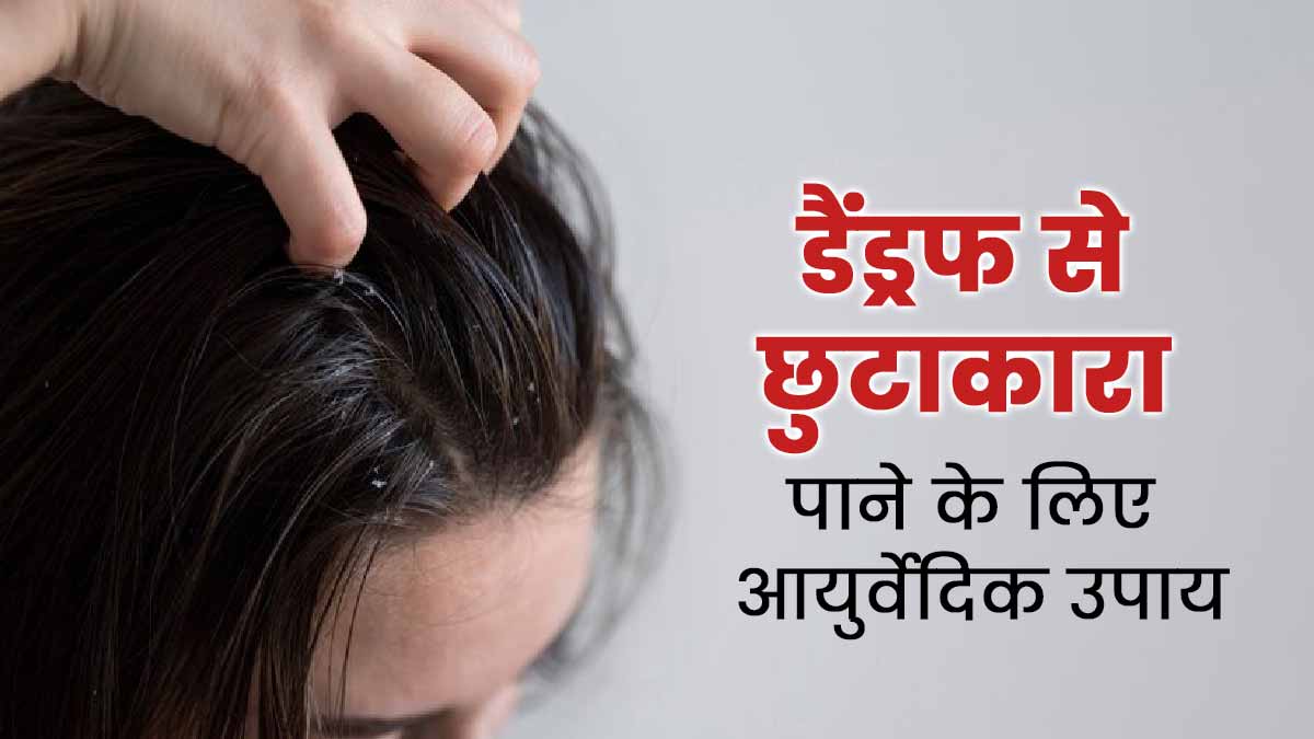 डैंड्रफ से छुटकारा पाने के लिए अपनाएं ये 2 आयुर्वेदिक उपाय, जल्द मिलेगी राहत 