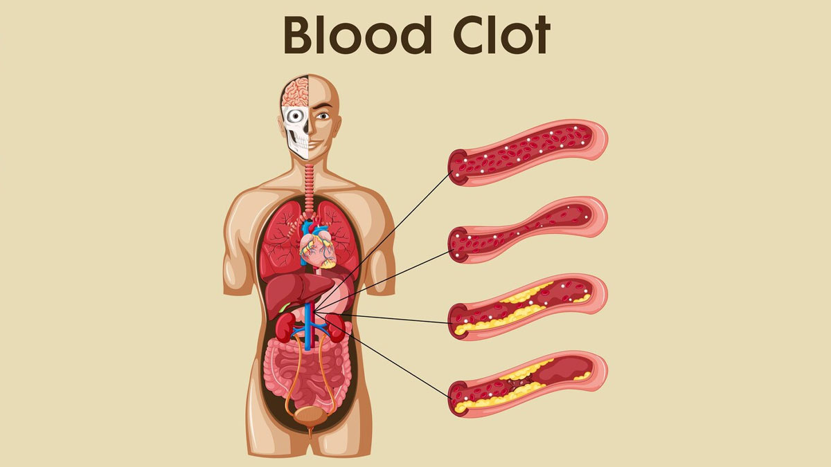 What Is A Blood Clot? Expert Explains This Condition, Its Symptoms, Causes, And Treatment