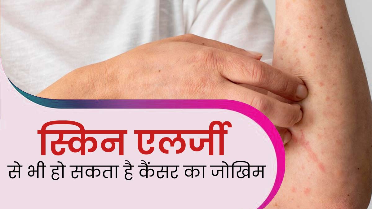 स्किन एलर्जी की वजह से भी बढ़ सकता है कैंसर का जोखिम, जानें दोनों में संबंध और बचाव के उपाय