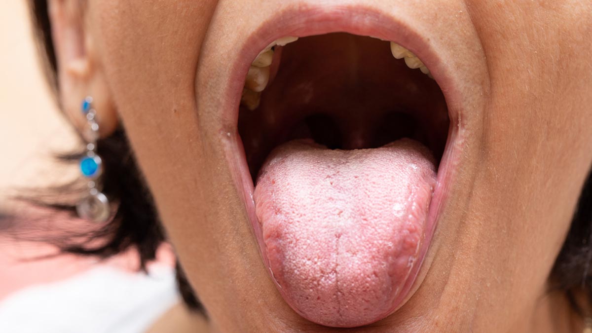 Oral Candidiasis: Expert Explains Why Elderlies Are More Prone To Get This Infection