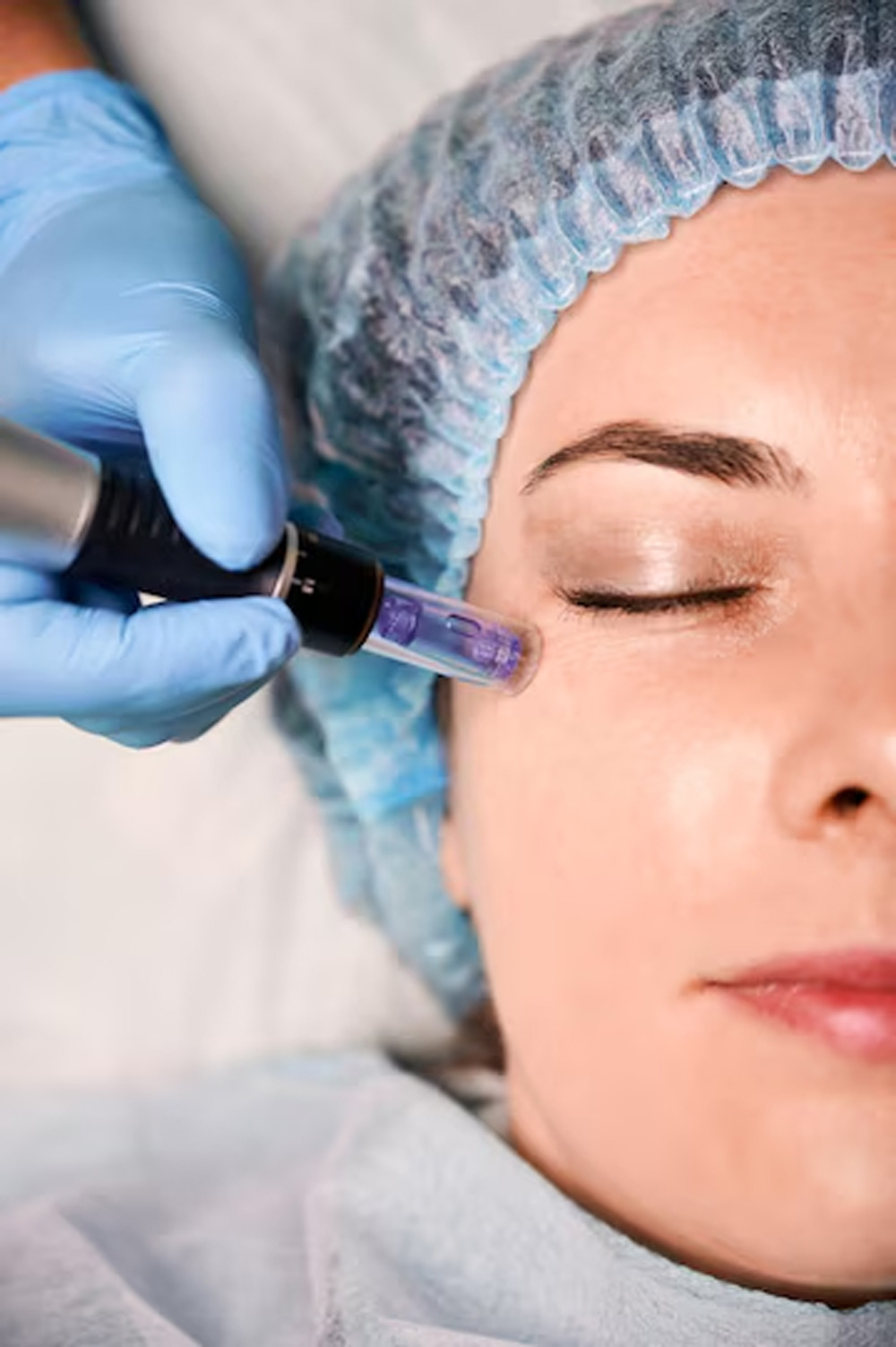 microneedlin