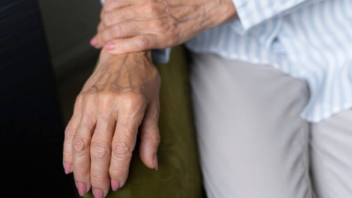 Psoriatic Arthritis Symptoms on Hands: