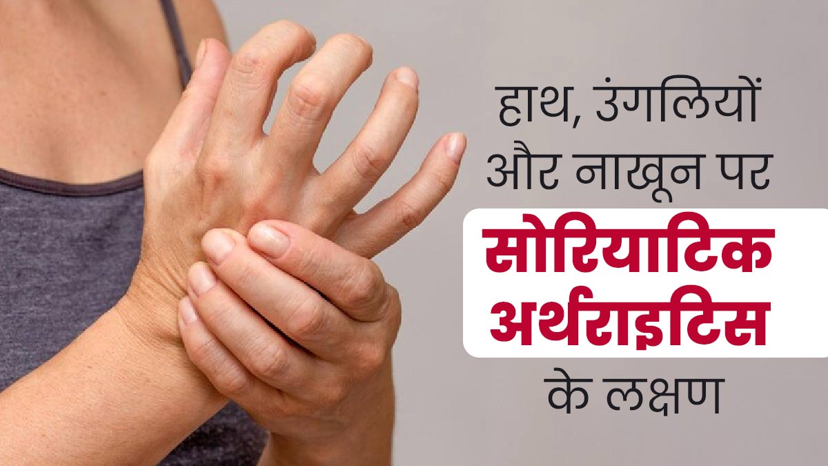 सोरियाटिक अर्थराइटिस में हाथ, उंगलियों और नाखून पर दिखाई देते हैं ये लक्षण, जानें बचाव