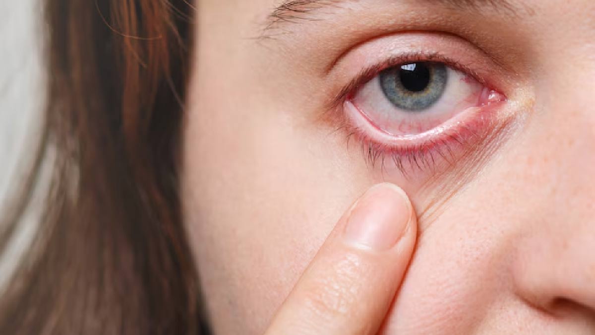Causes Of Eye Infection In Hindi