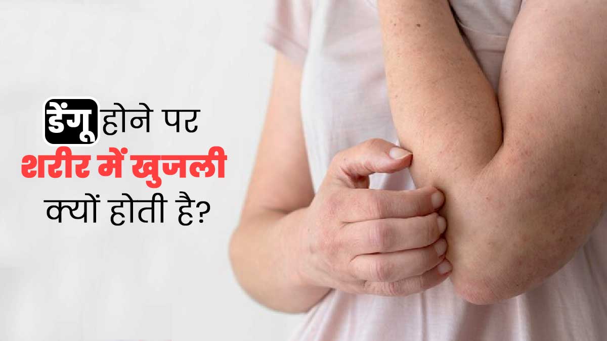 डेंगू बुखार के दौरान शरीर में खुजली क्यों होती है? जानें इसे ठीक करने के उपाय 