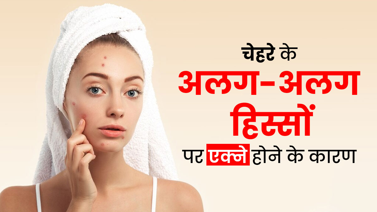 चेहरे के अलग-अलग हिस्सों पर एक्ने क्यों निकलते हैं? डॉक्टर से जानें कारण