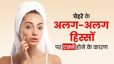 चेहरे के अलग-अलग हिस्सों पर एक्ने क्यों निकलते हैं? डॉक्टर से जानें कारण