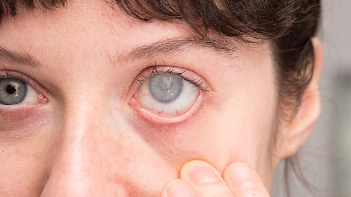 Cataract Surgery And Diabetes: Tips People With Diabetes Must Follow Before Surgery