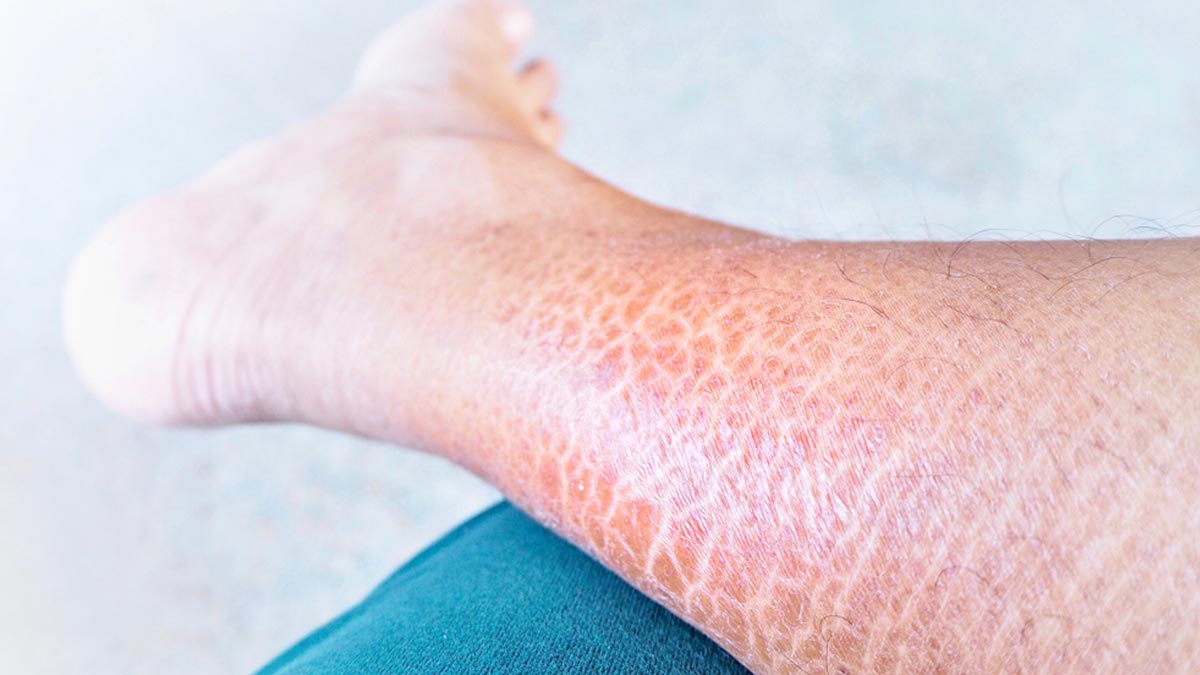 Understanding Ichthyosis: Expert Explains This Genetic Skin Disorder And Its Types And Management Measures