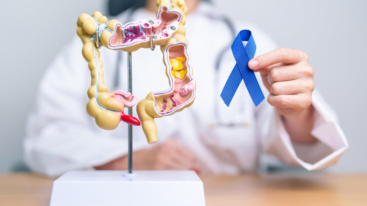 Doctor Recommends Starting Colon Cancer Screening At Age 45: Effective Screening Methods to Consider