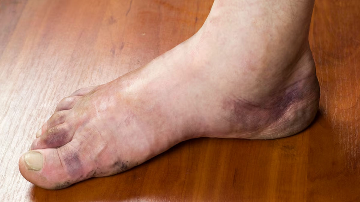 Taking Care Of Diabetic Foot In Monsoon: Tips To Try This Rainy Season