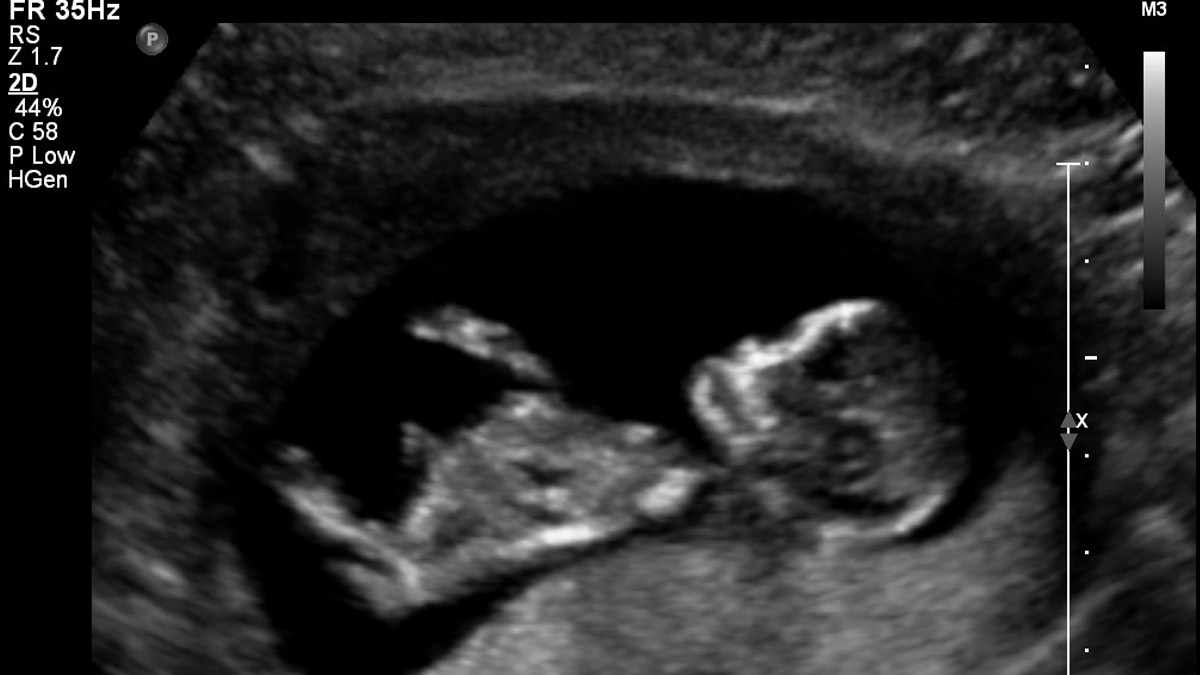 Pregnancy Loss Risk Heightened By Family History Of Endocrine Diseases: Research