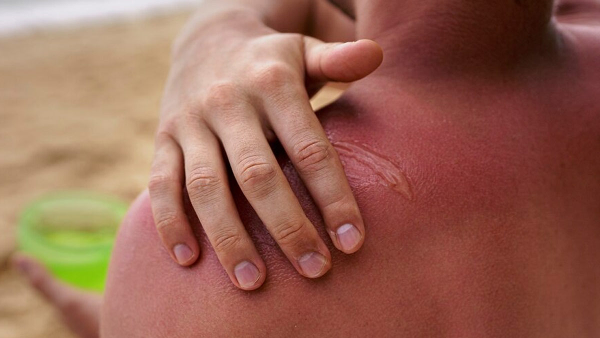 Skin Chafing: Here Are Effective Natural Remedies To Manage This Skin Issue At Home