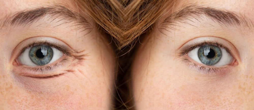 puffy eyes in pregnancy