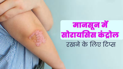 मानसून में सोरायसिस कंट्रोल रखने के लिए अपनाएं ये 5 टिप्स, आयुर्वेदिक एक्सपर्ट से जानें 