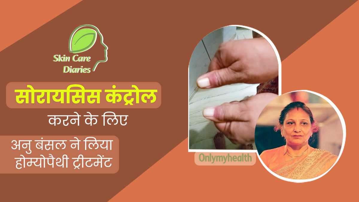 होम्योपैथी ट्रीटमेंट लेने से अनु बंसल को सोरायसिस में मिला आराम, एक्सपर्ट से जानें क्या है यह बीमारी
