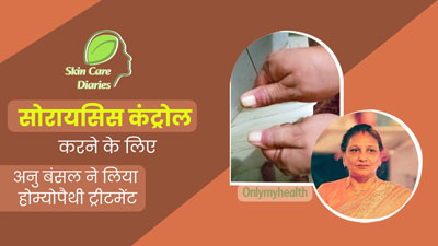 होम्योपैथी ट्रीटमेंट लेने से अनु बंसल को सोरायसिस में मिला आराम, एक्सपर्ट से जानें क्या है यह बीमारी