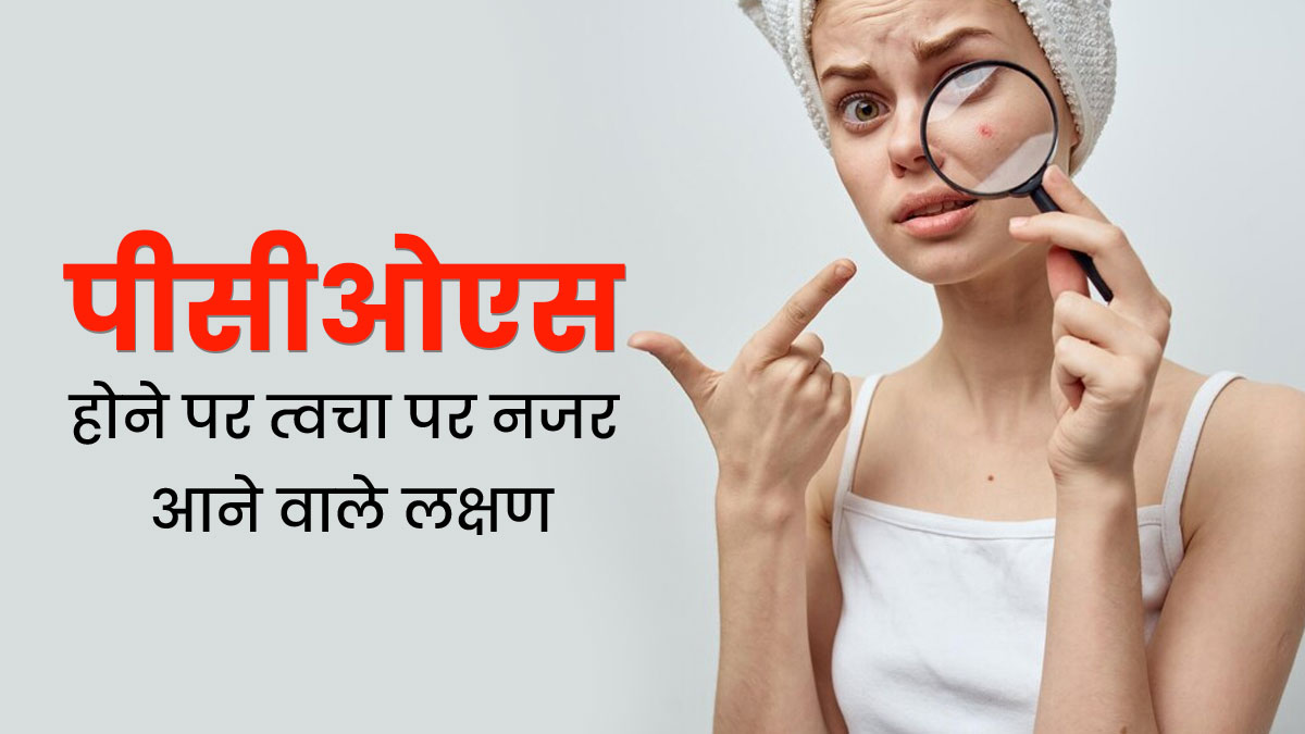 PCOS Symptoms: बार-बार चेहरे पर एक्ने होना PCOS का हो सकता है संकेत, जानें इसके अन्य लक्षण