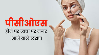 PCOS Symptoms: बार-बार चेहरे पर एक्ने होना PCOS का हो सकता है संकेत, जानें इसके अन्य लक्षण