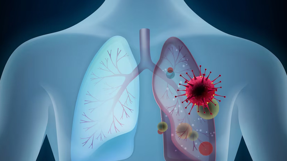 Why Is Lung Cancer Hitting Non-smoking Indians Earlier Than Westerners?