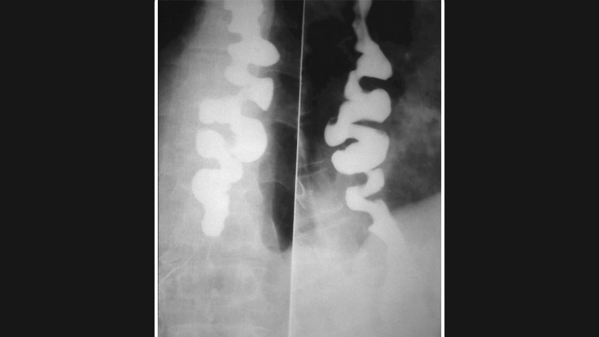 corkscrew esophagus